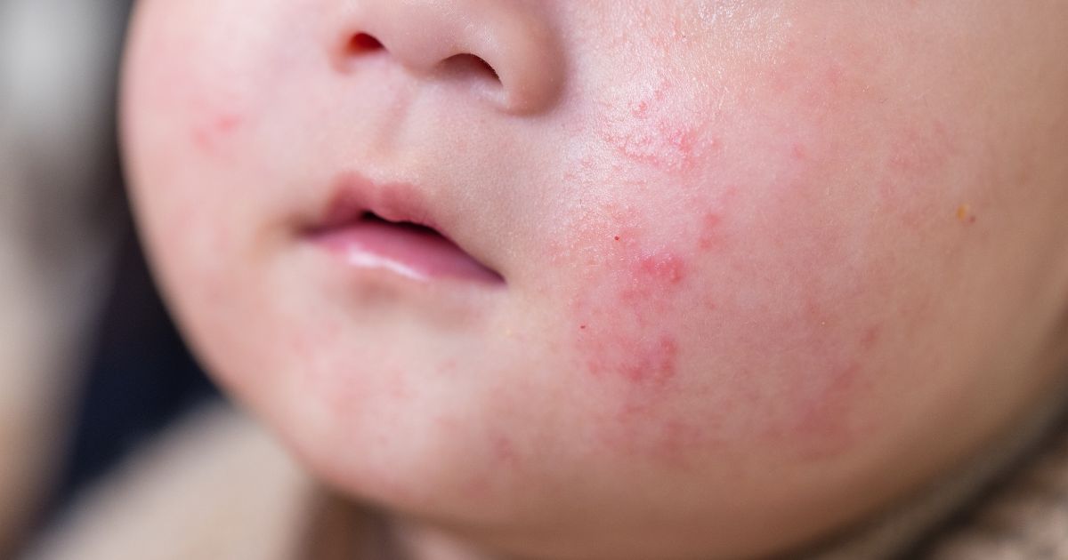 Anti-Allergy-Bedding-for-Children-eczema